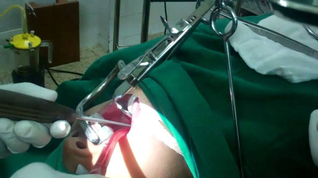 adenoidid