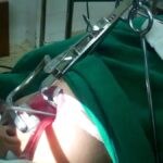 Adenoidid Removal Surgery: What to Expect from the Process